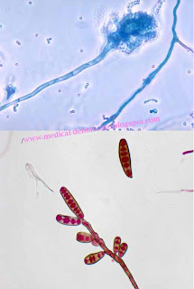 Fungal Meningitis Outbreak 2012