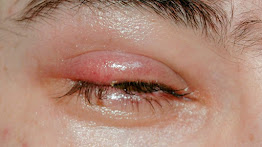 Pharmacotherapy of stye