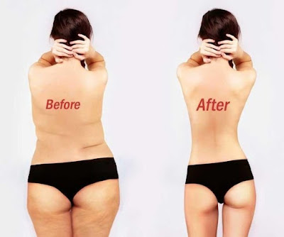 Liposuction in Mumbai