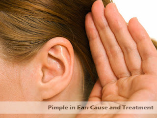 pimple in ear