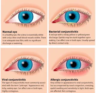 Know the Types, Treatments and Prevention of Infectious Eye Disease 