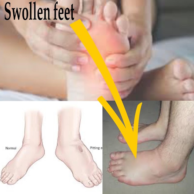 What’s inflicting those swollen feet.? But they could indicate a health condition.