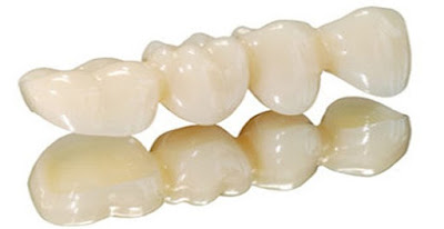 Khám phá răng sứ cercon có mấy loại tại nha khoa-1