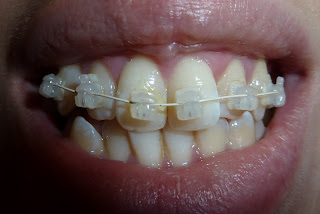 A photo of teeth with upper fixed ceramic braces