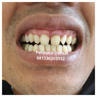 gambar foto contoh sebelum dan sesudah veneer gigi kelinci buatan manis cantik bali jember banyuwangi murah berkualitas di PERMATA DENTAL gambar gigi rusak yang di veneer gigi yang tidak rapi gigi renggang gigi patah cuil rompal pendek karies hitam kuning