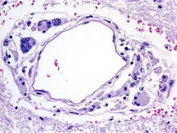 Malaria parasite, hiv Pathology,fnac pathology, tv pathology