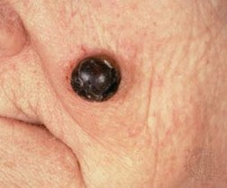 skin cancer pictures face