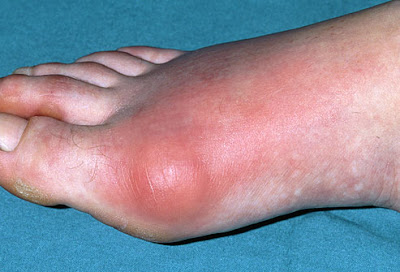 Bệnh gout thường xuất hiện các cơn đau dữ dội ở các khớp xương