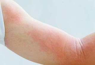 Anxiety rashes all over the patient's arms stress rash picture 