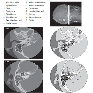 temporal bone ct