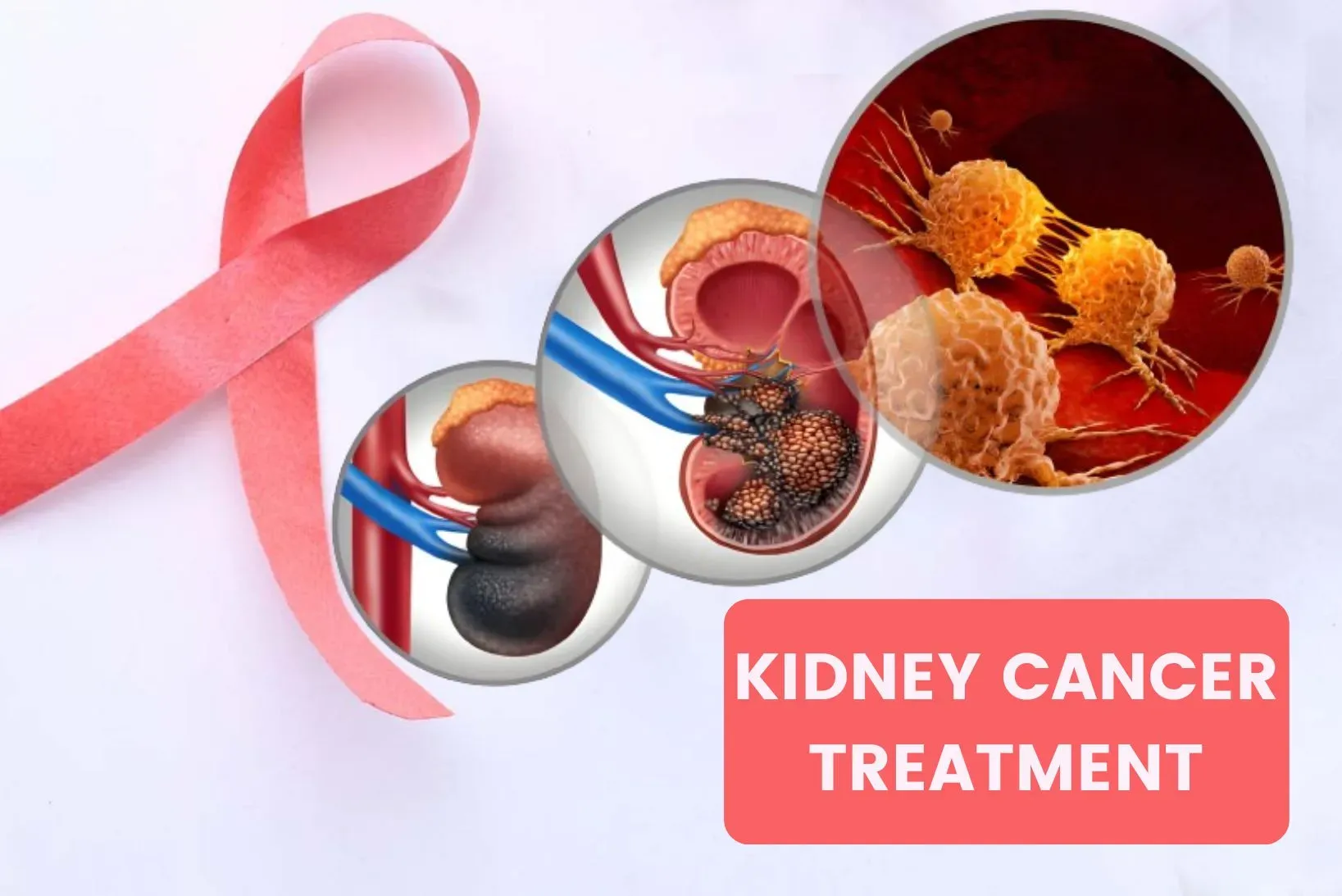 Kidney Cancer Symptoms, Diagnosis and Treatment