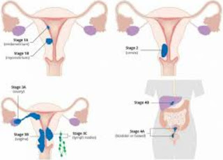 Artikel, Kanker Endometrium, Kanker Endometrium Adalah, Gejala Kanker Endometrium, Diagnosa Kanker Endometrium, Perawatan Kanker Endometrium