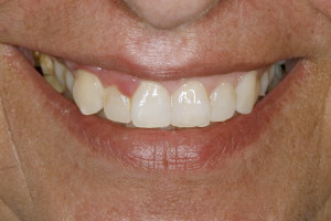 Razones por las un implante dental fracasa (Odontología)