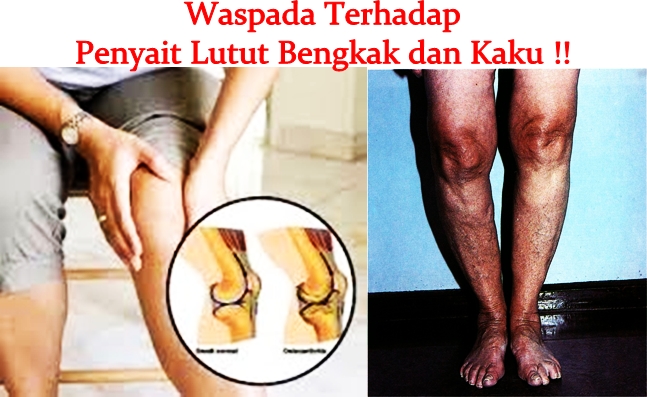 Pengobatan Tradisional Lutut Bengkak dan Kaku
