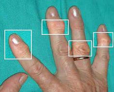 Mengobati Rheumatoid Arthritis