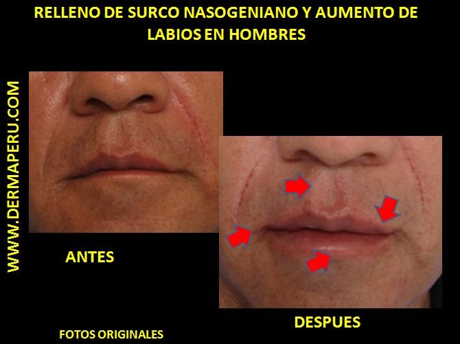 acido hialuronico labios barcelona