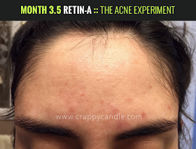 Month 3.5 on Retin-A :: The Acne Experiment