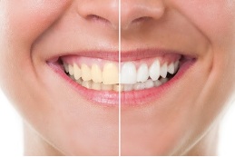 Recommend Teeth Whitening in a Dublin CA