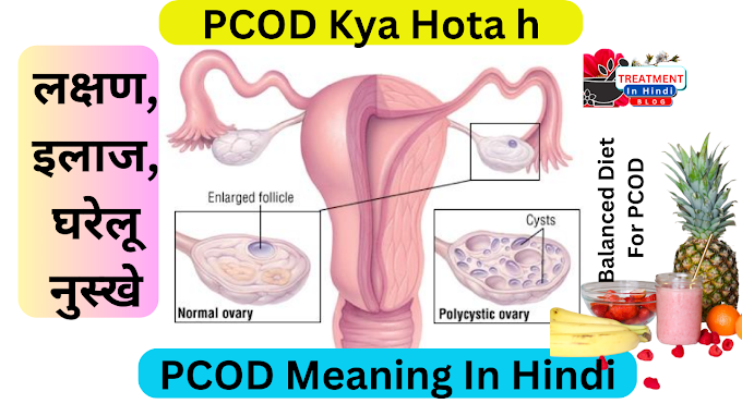 PCOD Kya Hota h | PCOD Meaning In Hindi- लक्षण, इलाज, घरेलू नुस्खे