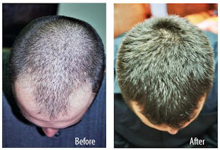 Details About Hair Regrowth De Processes