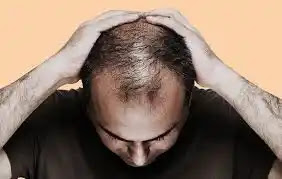 5 Meals That Prevents Hair Loss