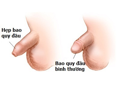 Hẹp bao quy đầu (trái) và bao quy đầu bình thường (phải)