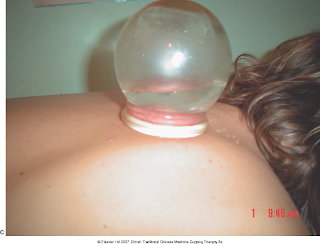 11 Methods of Cupping