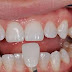 Răng móm có nên bọc sứ không?