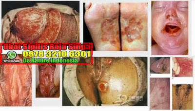 Obat Kencing Nanah - Obat Sipilis - Obat Raja Singa 