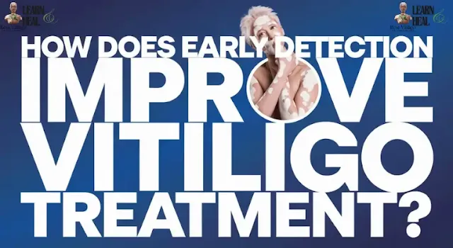 How does early detection improve vitiligo treatment?