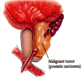 Images Prostate Cancer