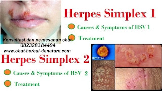 obat herpes kelamin,obat herpes zoster,obat cacar dompo,obat cacar air,obat herpes kemaluan,obat herpes tangan,obat herpes bibir,obat herpes badan