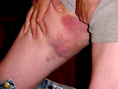 bruises