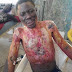 Graphic pics: Man sustains severe burns after someone poured gasoline on him and set him ablaze in Katsina State