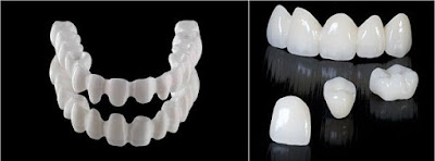 Quy trình và ưu điểm của bọc răng sứ Venus như thế nào?