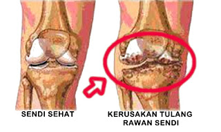 Kurangi gejala penyakit pengapuran