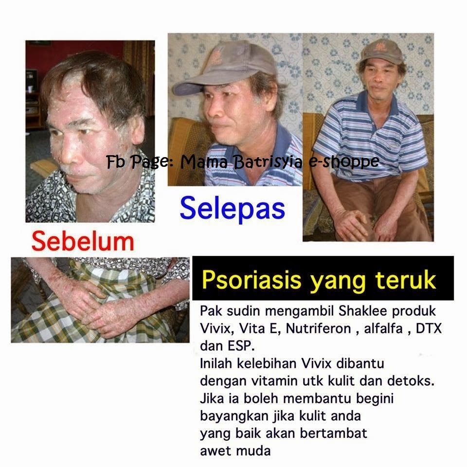 Kulit bersisik, berkeruping, gatal tanda Psoriasis  Amy 