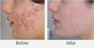 How Get Rid Of Acne Scars Overnight Naturally True Story By Alfie