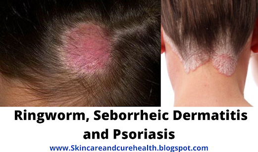 Ringworm, Seborrheic Dermatitis and Psoriasis