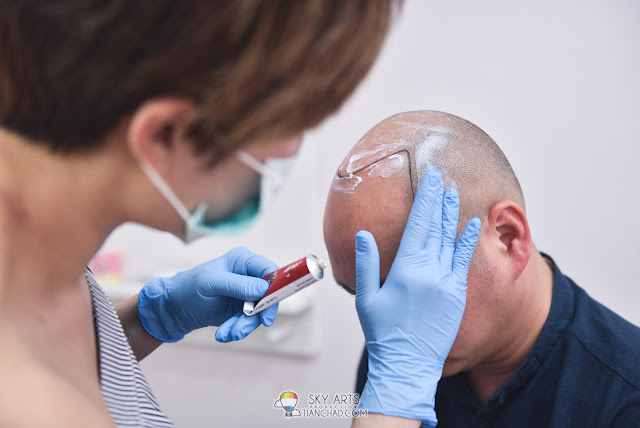 Apply numb cream before Scalp MicroPigmentation (SMP) treatment 