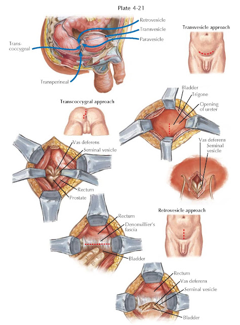 SEMINAL VESICLE SURGICAL APPROACHES