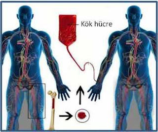 kök hücre nakli 