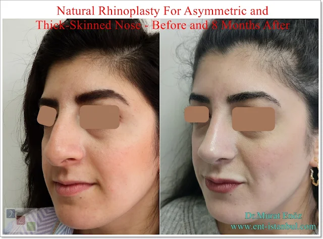 Natural rhinoplasty, Thick skinned nose job,Deviated nose,Crooked nose, Before and after 8 months of nose aesthetic