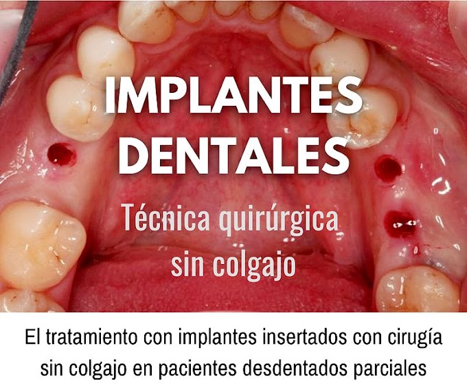 PDF: El tratamiento con implantes insertados con cirugía sin colgajo en pacientes desdentados parciales