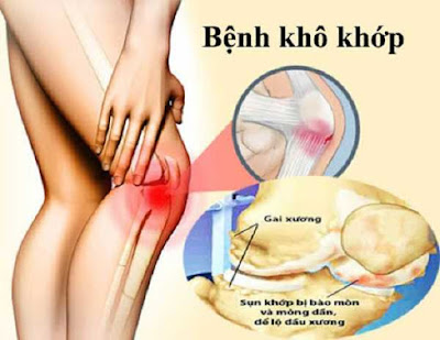 Bệnh khô khớp làm khó vận động