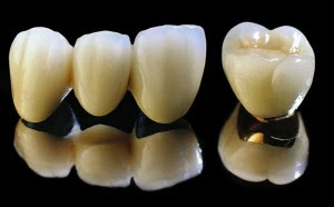 Đặc điểm của răng sứ titan