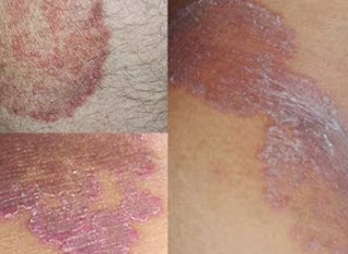 Gatal Di Ketiak Selangkangan, Cara Mengatasi gatal eksim Di Kaki, Obat Herbal gatal eksim Dermatitis, obat gatal seperti eksim, Obat Gatal Di Selangkangan Karena Jamur, Obat gatal eksim Pada Leher, Penyakit gatal eksim Dan Cara Mengatasinya, Jamu gatal eksim Cap Cobra, Obat Eksim Gatal2, Eksim Hiv, Tanaman Obat Untuk Eksim Kering, gatal eksim Atau Dermatitis Adalah, Mengatasi Eksim Pada Wajah, Gatal Di Kemaluan Bumil, Eksim Basah Obat, Obat Eksim Kering Ampuh, Gatal Di Selangkangan Dan Cara Mengatasinya, Cara Mengobati Eksim Kulit, Cara Mengobati gatal eksim Pada Telapak Tangan, Obat Eksim Kering Alami, Penyakit Eksim Kering Pada Bayi, gatal eksim Atopik Adalah, Mengobati Eksim Dengan Kunyit, Ciri Eksim Sembuh, Cara Mengobati Penyakit gatal eksim Di Kaki, gatal eksim Basah Pada Anak, Contoh Eksim, Obat Eksim Lidah Buaya 