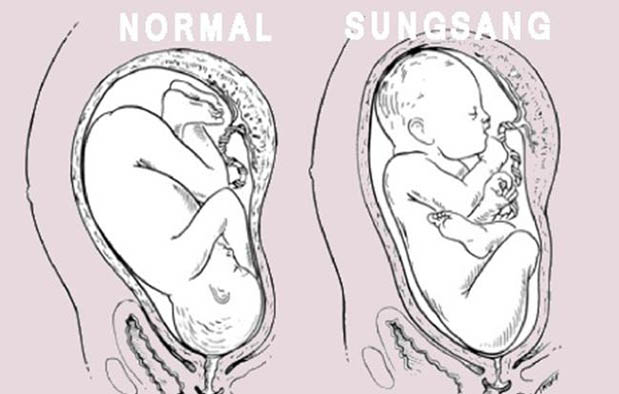 Cara Mengatasi Bayi Sungsang semoga Lahir Normal