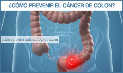 ¿Cómo prevenir el Cáncer de Colon? Sigue estos 10 sencillos consejos