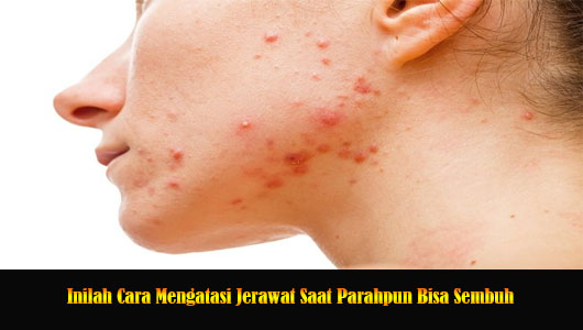 Inilah Cara Mengatasi Jerawat Saat Parahpun Bisa Sembuh